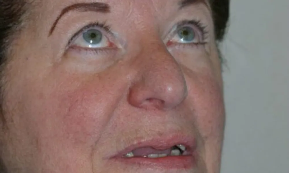 Clinical photo from Kathy's full-arch dental implant case